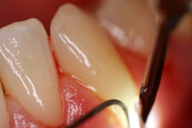 хронический пародонтит